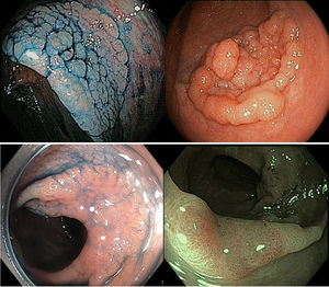LST morphology examples and its association to submucosal invasion in the Spanish and Japanese cohorts.