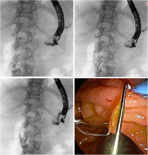 Pancreatograhy via EUS-guided transgastric puncture of pancreatic duct using 22-G needle. Anterograde advancement of a 0.018-in. guidewire through the stricture. Anterograde guidewire crossing the minor papilla until the duodenal lumen by fluoroscopy and endoscopy view (metallic clip located at major papilla).