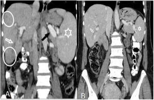 (A and B): Hepatomegaly, splenomegaly (asterisk), enlarged portal and splenic veins (black arrow), subcapsular hypodense area (circles), and intrahepatic biliary dilatation/thickening in segment VI (white arrow) in a 46-year-old woman (A). Changes of the findings on post-treatment scan are seen in (B).