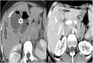 (A and B): Liver abscess larger than 3cm (asterisk) and subcapsular microtubule abscess (black arrow) in a 20-year-old woman (A). After treatment, regression in the abscess and in the other lesions is seen (B).