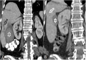 (A and B): Hypoattenuating areas extending from capsule into the parenchyma (black arrow) and subcapsular hematoma (asterisk) (A). After treatment, regression of hypodense areas (white arrows) and marked regression of subcapsular hematoma (B).