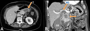 (A) CT: adenosquamous tumor in distal pancreas. (B) CT: adenosquamous tumor in pancreatic head. T: tumor. GB: gallbladder. BD: bile duct.