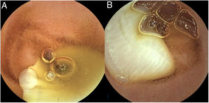 Capsule endoscopy revealing genital pores (A) and numerous (>12) uterine branches (B) in the proglottids, in relation to a Taenia saginata infection.