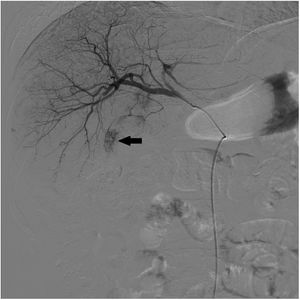 Arteriografía de arteria hepática común previa a embolización en la que se objetiva una lesión tumoral en lóbulo hepático derecho (flecha negra) en relación con carcinoma hepatocelular que se nutre de la arteria del segmento VI en su mitad superoexterna.