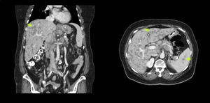 Tomografía abdominal con corte coronal y transversal en la que se evidencian múltiples lesiones hepatoesplénicas compatibles con la afectación por sarcoidosis.