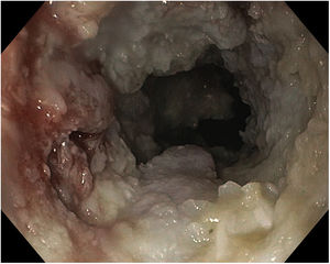 Imagen de endoscopia digestiva alta en la que se observa mucosa esofágica de aspecto polipoide cubierta por placas blanquecinas.