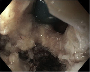 Imagen de endoscopia digestiva alta de control de la fístula broncoesofágica tras la colocación de prótesis bronquial mediante broncoscopia.