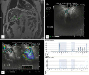 (a) Magnetic resonance on the T2-weighted imaging (WI) showed a distal stenosis and dilation of the common bile duct (arrow) and a proximal tumoral mass. (b) Lineal endoscopic ultrasound image showing the distal bile duct stenosis. (c) Lineal endoscopic ultrasound image showing the proximal mass protruding into the proximal common bile duct (left image). The same mass is enhanced by elastography (right image). (d) Pyrogram trace of the codons 12 and 13 of KRAS oncogene from the distal cholangiocarcinoma. Notice the double hight of the G peak at position 4, characteristic of the wild type GGT sequence at codon 12 (left shadowed box). (e) Pyrogram trace of the codons 12 and 13 of KRAS oncogene from the proximal cholangiocarcinoma. Notice the presence of the A peak at position 5 resulting from the GGT>GAT mutation at the second base of codon 12 (left shadowed box).