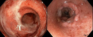 Imagen colonoscópica de muñón rectal previo a la cirugía, y de anastomosis posterior. En la imagen de la izquierda, podemos observar el muñón rectal previo a la reconstrucción del tránsito, con una mucosa eritematosa, friable y con pérdida del patrón vascular. La imagen de la derecha es el estado de la anastomosis colorrectal en su última colonoscopia, con integridad de la misma pero persistiendo la friabilidad de la mucosa.