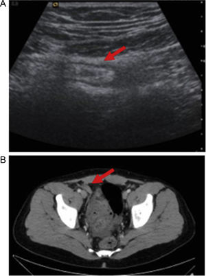 Ecografía (A) y TAC de abdomen (B): apéndice aumentado de volumen (flecha roja).