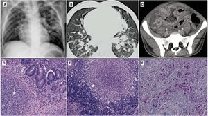 A) Radiografía de tórax posteroanterior: opacidades múltiples periféricas en ambos lóbulos sugerentes de infección por SARS-CoV-2. B) Tomografía computarizada torácica: condensación alveolar parcheada, de morfología nodular a nivel central y periférico, compatible con proceso infeccioso. C) Tomografía computarizada abdominal (corte axial): asas de intestino delgado de pared engrosada con absceso interasas en el promontorio. D) Granuloma necrosante con inflamación aguda añadida (asterisco) en relación con la mucosa-submucosa cecal (tinción hematoxilina-eosina, 100×). E) Granuloma necrosante con fenómenos de abscesificación en tejido linfoide ganglionar (asterisco) tinción hematoxilina-eosina, 100×). F) Abundantes BAAR en áreas de necrosis granulomatosa (Ziehl-Neelsen, 400×).