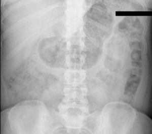 Dilatación gástrica en Rx simple de abdomen.