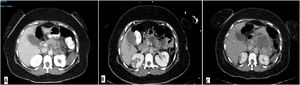 Evolución de la pancreatitis isquémica en la TAC abdominal. A) TAC al ingreso en el que se aprecia pancreatitis aguda con necrosis pancreática a nivel a nivel del cuerpo pancreático, con necrosis menor al 20% de la glándula. B) TAC de control en el que persisten signos de necrosis con colecciones de pared no definida alrededor de cuerpo y cola pancreática, similar a previo. C) TAC al mes en el que se objetivan signos de pancreatitis necrótico-hemorrágica severa (índice de severidad de Mortele 10), con extensa necrosis en cola pancreática (mayor del 30%) con colección heterogénea sugerente de necrosis encapsulada de unos 7,7×6cm.