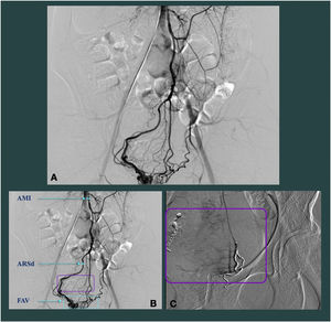 A. Angiografía. B. AMI: arteria mesentérica inferior; ARSd: arteria rectal superior derecha (origen de la fístula); FAV: fístula arteriovenosa. C. Colocación de microcoils en las arterias rectales superiores.