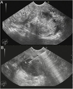 EUS. (A) Collapsed WON in the body of the pancreas with a minimum liquid component; (B) partially re-expanded WON after saline instillation through a 19G needle.