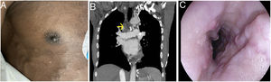 A) Abundantes colaterales cutáneas. B) Trombosis crónica de cava superior en TAC (flecha). C) varices proximales con tetón de fibrina.