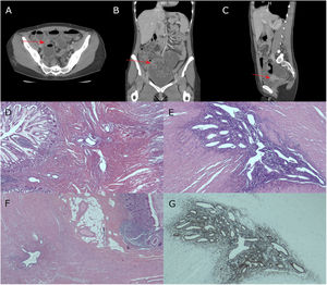 (A) Axial image of an abdominopelvic CT scan showing concentric mural thickening of the distal ileum, consistent with complete small bowel obstruction. (B) CT coronal image. (C) CT sagittal image. (D) HE staining (4×): focus of endometriosis in the distal ileum. (E) HE (10×) Detail of a nest rich in glands and endometrial stroma in the ileal muscular layer. (F) HE (4×) Focus of endometriosis within the appendicular wall. (G) HE (10×). Positivity for estrogen receptors in the endometrial glands of the distal ileum.
