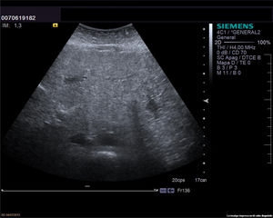 Ultrasound examination showing increased ecogenicity, nodular surface and heterogeneous ecostructure.