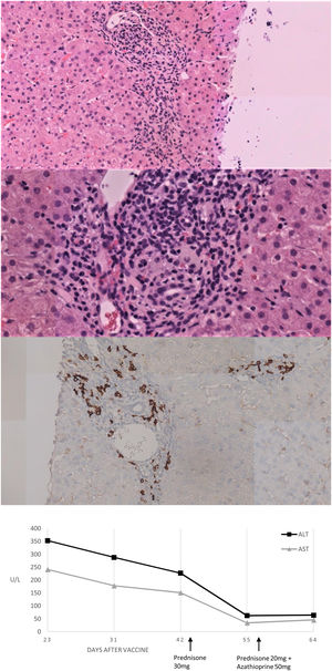Histological and biochemical findings. (A, B) H&E stain low-magnification (×20 and ×40 respectively) shows lymphoplasmacytic portal infiltrate with focal disruption of the limiting plate. No evidence was found of histologic cholestasis, fibrosis or iron deposit. (C) Immunohistochemical study of plasma cells expressing CD38. (D) Biochemical trend of plasma ALT and AST over time.
