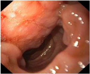 Endoscopia digestiva alta donde se muestra la tumoración.