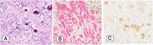 Imagen microscópica: Hematoxilina-Eosina con núcleos eosinófilos pequeños e hipercromáticos (A); positividad para sinaptofisina (B); positividad para somatostatina (C).