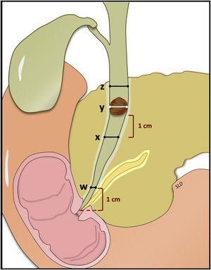 Imagen cortesía del Dr. López Durán. z=diámetro más ancho del conducto biliar extrahepático; y=diámetro transversal del cálculo; x=diámetro del conducto biliar extrahepático 1cm bajo el cálculo; w=diámetro del colédoco 1cm sobre orificio papilar. Colédoco en embudo: w<z. Litiasis impactada: y>x.
