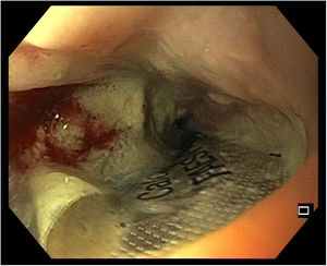 Blister ocluyendo luz esofágica.
