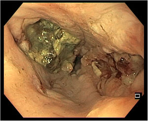 Úlceras profundas bilaterales tras extracción de blister.