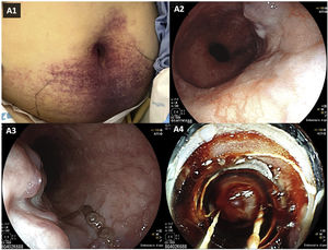 Inspection of the abdomen (A1) and endoscopic views of the esophagus (large esophageal varices [A2], white nipple sign [A3], band ligation [A4]).