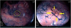 Neoplasia gástrica precoz antral de 11×9mm (círculo amarillo) en visión lejana. Cromoendoscopia con índigo-carmín (izquierda). En visión cercana se observa nítidamente la irregularidad del patrón glandular superficial en el interior de la línea de demarcación (flechas amarillas) (derecha).
