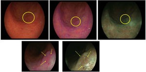 Neoplasia gástrica precoz con histología en toma de biopsias de displasia de bajo grado en curvatura mayor del antro. A)Imagen de luz blanca con alta definición. B)Color violáceo en imagen LCI. C)Imagen BLI. D)Imagen LCI con magnificación. E)Imagen BLI con magnificación. En D y E se observa línea de demarcación periférica y distorsión del patrón superficial y microvascular en su interior.