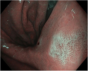 Foco de metaplasia intestinal (MI) próximo a la incisura, imagen M-NBI. Se observan con nitidez las imágenes de light blue crest.