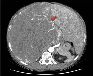 Corte transversal de tomografía computarizada abdominal con contraste en que se observa hepatomegalia que ocupa ambos hipocondrios con hemangioma cavernoso gigante en lóbulo hepático derecho.