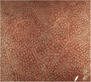 Patrón normal de la mucosa de cuerpo gástrico con endoscopia sin magnificación (Fujifilm «blue laser imaging» [BLI]) observando las glándulas que se disponen verticalmente y las aberturas de las criptas redondeadas.