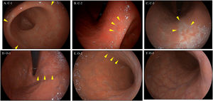Kimura-Takemoto classification with High-Definition White-Light endoscope by SonoScape. (A) C-1: atrophic border is identified in antrum or incisura angularis. (B) C-2: atrophic border reaches to the distal area of lesser curvature of gastric body. (C) C-3: atrophic border reaches to the proximal area of lesser curvature of gastric body. (D) O-1: atrophic border no longer lies on the lesser curvature, but instead between the lesser curvature and anterior wall. (E) O-2: atrophic border affects anterior wall of the gastric body. (F) O-3: atrophic border affects the greater curvature of gastric body (in this case atrophy affects all gastric body). Arrowheads indicate the atrophic border.