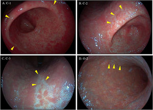 SFI virtual chromoendoscopy by SonoScape has an optical phase followed by digital processing. In the optical phase, the blue-violet light is intensified at 415nm where the hemoglobin light absorption peaks. The digital processing then sharpens and de-noises the image, while increasing the brightness and further the contrast. (A) C-1; (B) C-2; (C) C-3; (D) 0–2. Arrowheads indicate the atrophic border.