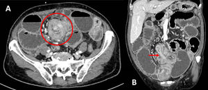 Imagen de la tomografía computarizada. A) Corte axial: «signo del donut» o «signo de la escarapela». B) Corte coronal.