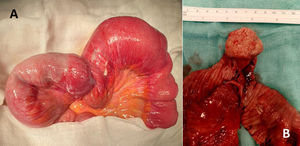 Hallazgos intraoperatorios. A) Invaginación intestinal íleo-ileal. B) Lesión polipoidea intraluminal (pólipo fibroide inflamatorio o tumor de Vanek) en la pieza quirúrgica seccionada.