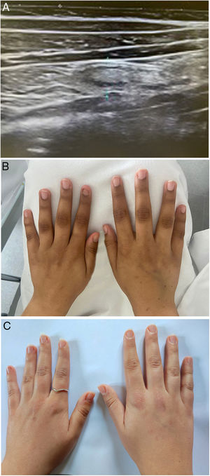 (A) Ultrasound imaging of cecoileitis. (B) Hands hyperpigmentation at diagnosis. (C) Resolution of hyperpigmentation after treatment