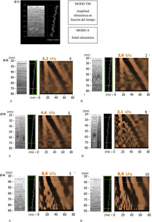 Ejemplos de imágenes elastográficas. (2.1) Imagen elastográfica modelo. (2.2) Imagen elastográfica en paciente delgado. A. Imagen correcta. En apnea. B. Imagen con artefactos. Respiración sin apnea. (2.3) Imagen elastográfica en paciente nervioso. A. Imagen correcta. Paciente relajado B. Imagen con artefactos. Paciente nervioso. (2.4) Imagen elastográfica en paciente obeso. A. Imagen correcta. Apnea y estirando el tejido adiposo. B. Imagen con artefactos. Respiración sin apnea.