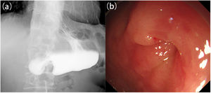 Preoperative examinations. (A) Preoperative barium study showed a narrow pylorus and a distended gastric antrum, with no obvious passage of barium. (B) Endoscopy revealed a unique “cervix sign”.