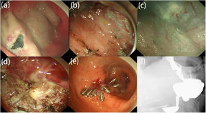 Endoscopic radial pyloromyotomy for adult idiopathic hypertrophic pyloric stenosis. (A) Mucosal entry 5cm proximal to the pylorus. (B) Creation of a wide submucosal tunnel up to the duodenal bulb. (C) Adequate exposure of the pyloric ring. (D) Radial pyloromyotomy of the circular muscle. (E) Closure of the tunnel entry with endoscopic clips. (F) Rapid passage of barium from stomach into the duodenum after radial pyloromyotomy.
