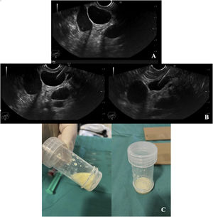 (A) Peripancreatic cystic lesion (peripancreatic lymphangioma); (B) EUS-FNA of cystic lesion; (C) Milky fluid obtained from EUS-FNA.