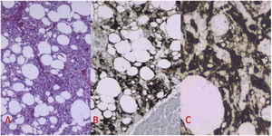Estudio anatomopatológico e inmunohistoquímico. A) Anatomía patológica (HE, 4x): células epitelioides, muy vascularizadas, con gran entramado de tejido adiposo. B) Inmunohistoquímica: positividad para HMB-45, en contraste con el parénquima pancreático adyacente. C) Inmunohistoquímica: positividad citoplasmática para MELAN-A.