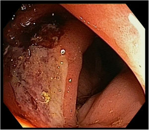 Hallazgos endoscópicos: lesión ulcerada en colon ascendente.