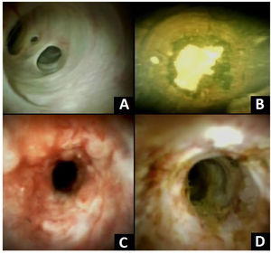 (A) A normal common bile duct visualized by cholangioscopy. (B) A choledocholithiasis that completely occupies the entire duct. (C and D) Indeterminate biliary strictures with tortuous vessels, ulcerated areas and irregular surfaces which are suggestive of a cholangiocarcinoma.