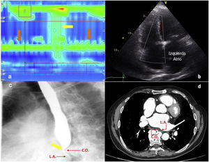 Disfagia megalatriensis y compresión esofágica por osteofito cervical. 1a) MAR que objetiva hiperpresión medioesofágica pulsátil (flechas naranjas) y presurización compartimentalizada secundaria (flecha amarilla). 1b) ETT que muestra dilatación de aurícula izquierda. 1c) TEGD con fenómeno de doble compresión medioesofágica y afilamiento (flecha amarilla) por aurícula izquierda y osteofito cervical (puntas de flecha rojas). 1d) TAC torácico con contraste que muestra colapso esofágico por compresión extrínseca (puntas de flecha rojas). A.I.: aurícula izquierda; O.C.: osteofito cervical.