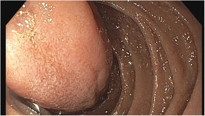 Large duodenal lipoma arising in the D2 duodenum.