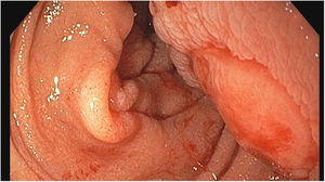 Ulcerated head of the lipoma.