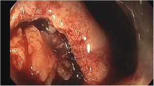 Lipoma after the partial endoscopic resection.